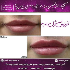 تزریق-ژل-لب-1