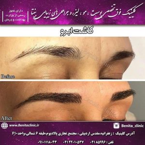 کاشت-ابرو-1